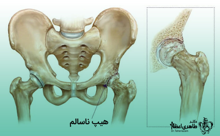 آرتروز و لگن درد