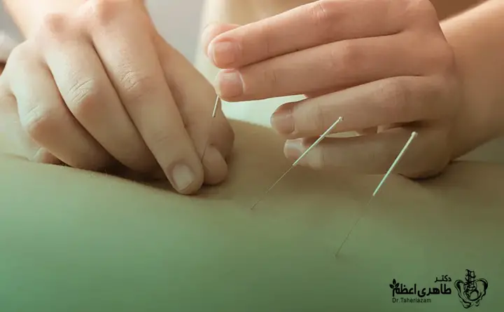 طب سوزونی برای درد سیاتیک