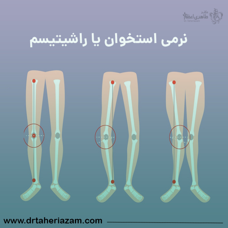 نرمی استخوان چیست؟ آیا نرمی استخوان خطرناک است؟