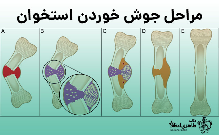 مراحل جوش خوردن استخوان
