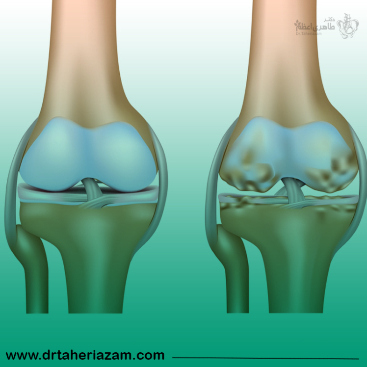 آرتروز زانو + علل، علائم و روش های درمان آرتروز مفصل زانو