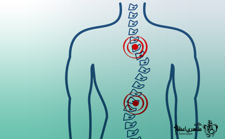 دیسک کمر و خواب رفتن دست و پا