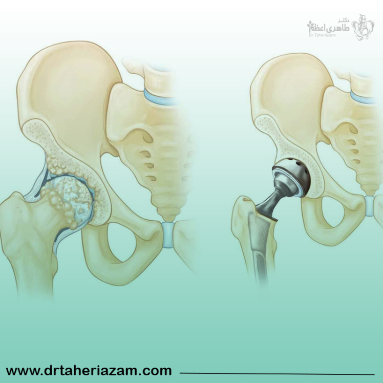 عمر مفصل مصنوعی لگن چقدر است؟ | عوامل موثر بر طول عمر مفصل مصنوعی لگن 