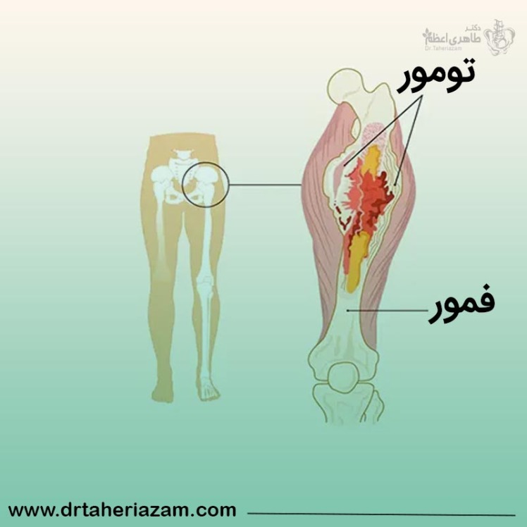 انواع تورمور استخوان | آیا تومورهای استخوانی درمان دارند؟