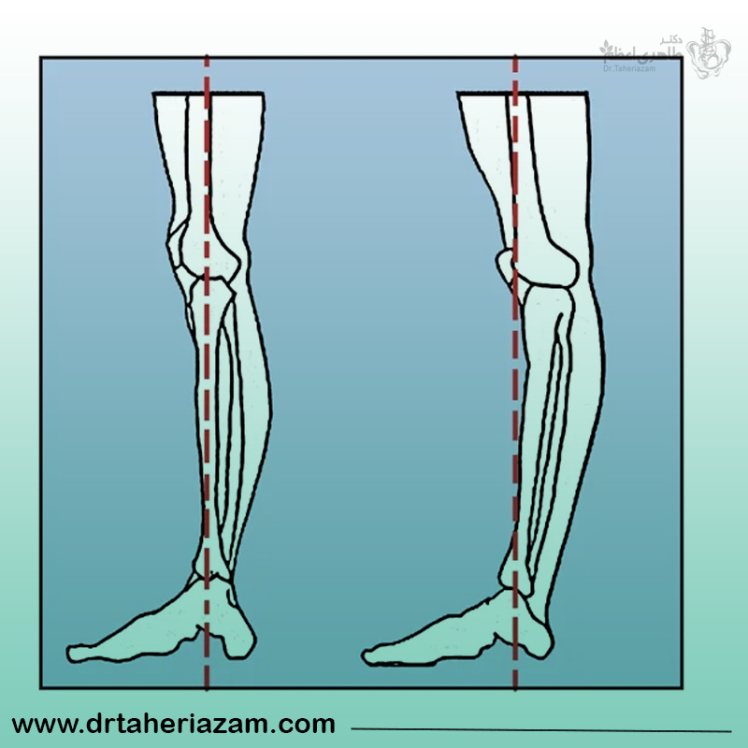عقب زدگی زانو؛ علل، علائم، تشخیص و درمان