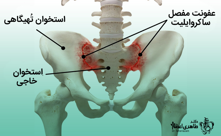 عفونت مفاصل ساکروایلیاک