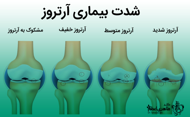 درمان آرتروز چگونه ممکن است؟