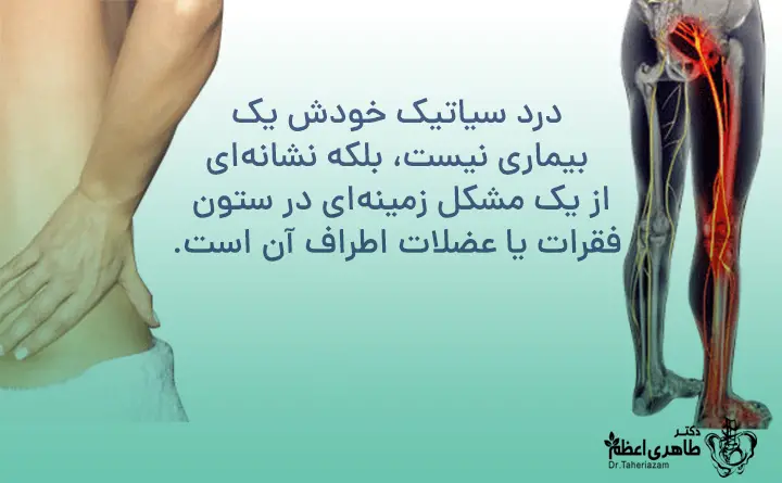 سیاتیک چیست و چه علائمی دارد