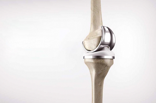 سن مناسب جراحی تعویض مفصل زانو (ایمپلنت زانو) چیست؟
