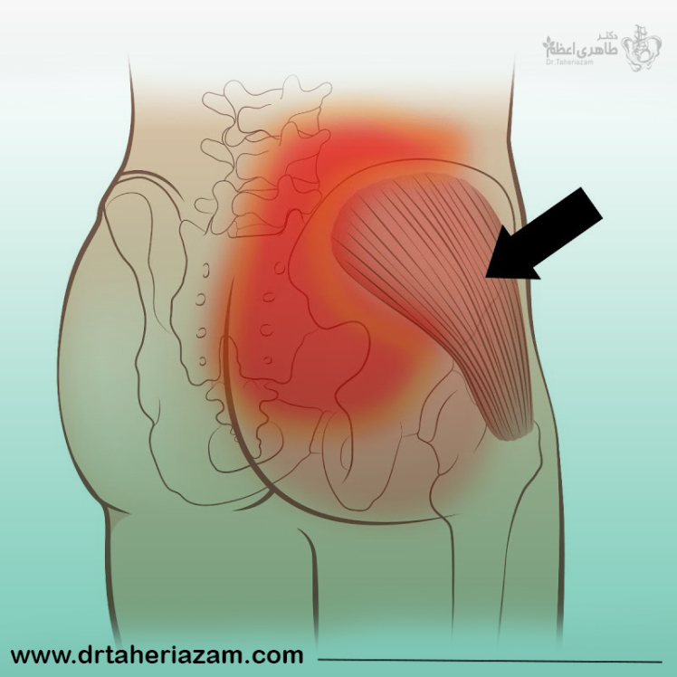 15 دلیل درد مفصل ران و لگن | تشخیص و درمان دردهای لگن
