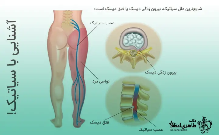 علائم سیاتیک در زنان