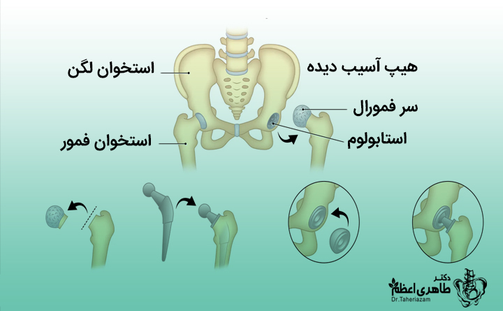 پروتز لگن چقدر عمر دارد؟