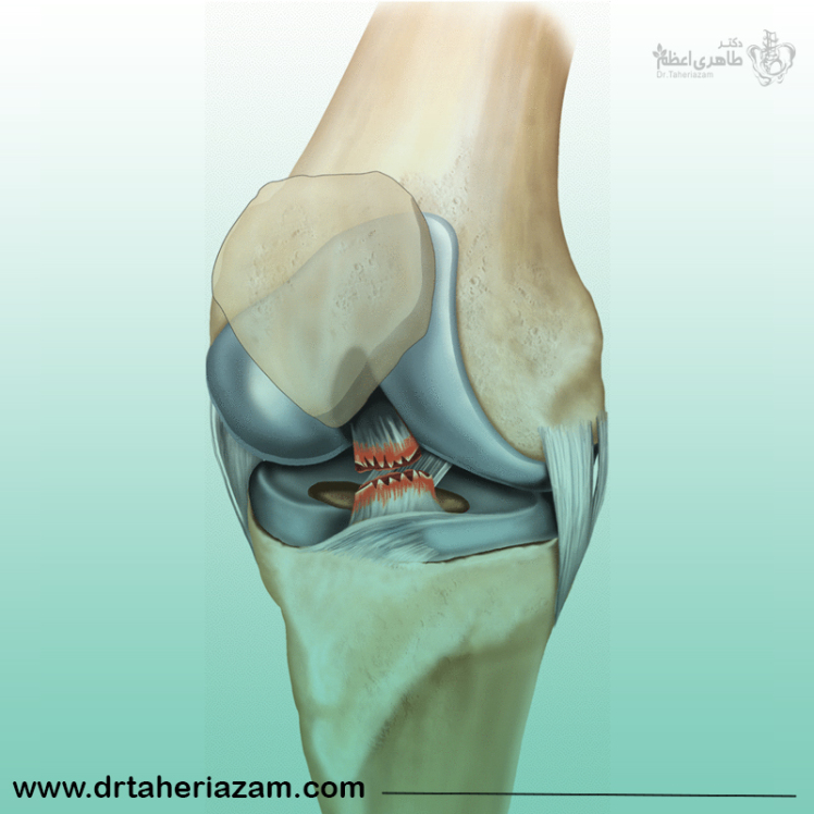 پارگی رباط صلیبی + روش های درمان پارگی رباط صلیبی