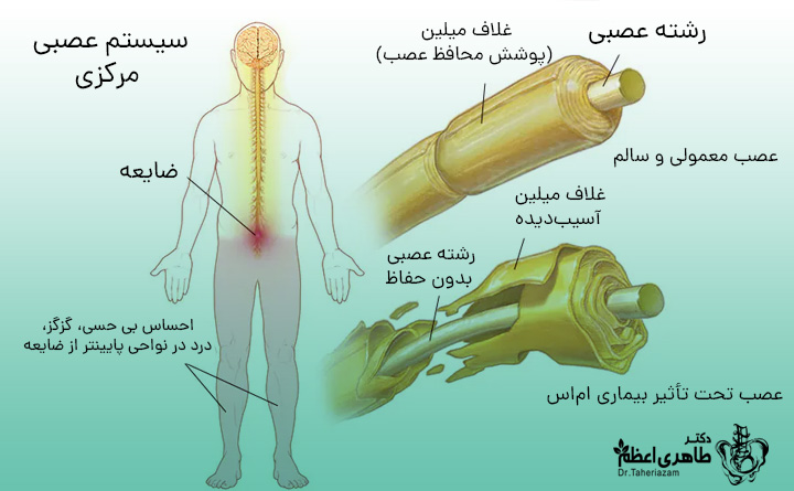 بیماری ام اس و صعف عضلانی