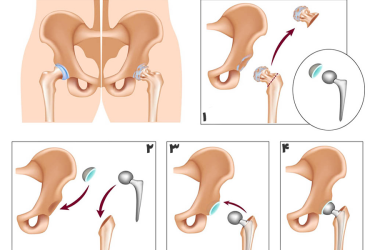 تعویض کامل لگن‌ ​​​​​​​ (Total Hip Replacement)