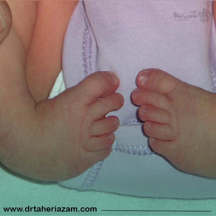 کلاب فوت یا پا چنبری چیست؟ علل و پیشگیری از کلاب فوت در جنین