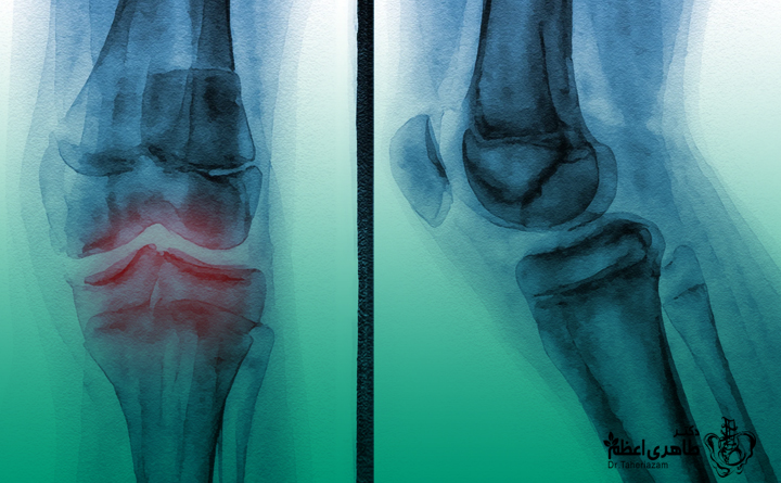 چه عواملی باعث ایجاد آرتروز میشود