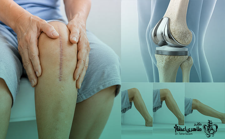 دلایل خشکی زانو پس از عمل تعویض مفصل