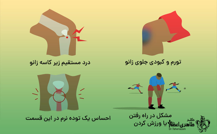علائم آسیب به تاندون های زانو