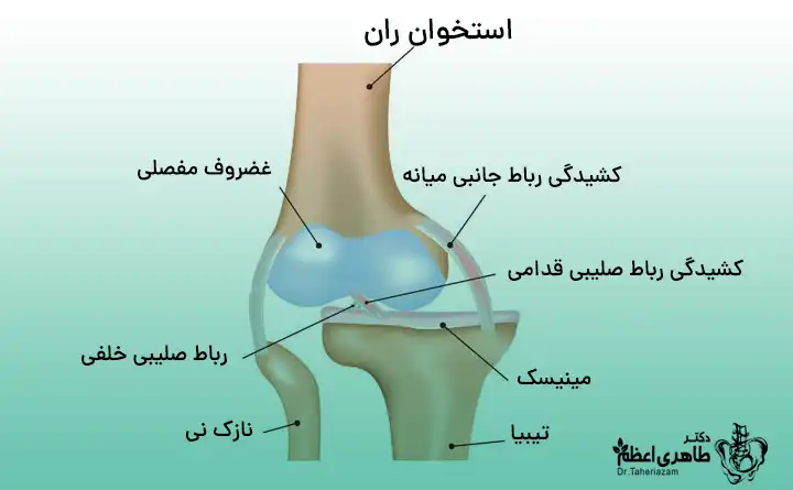 درمان در رفتگی زانو