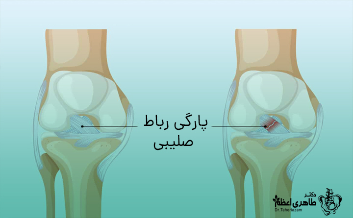 پارگی رباط صلیبی