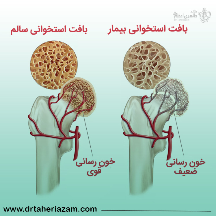 سیاه شدن استخوان به چه معناست؟ علت سیاه شدن استخوان