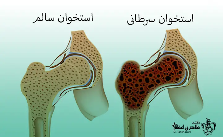 سرطان استخوان در ساق پا