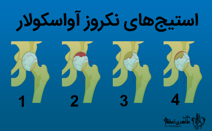 نکروز آواسکولار