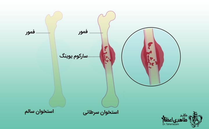 درمان توده استخوانی