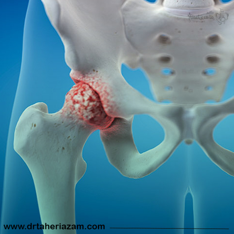 ساییدگی مفصل لگن یا آرتروز لگن | علل و علائم + روش های درمان آرتروز لگن