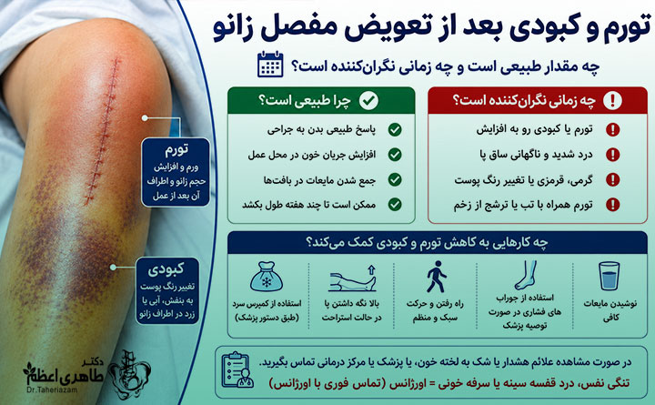 تورم و کبودی بعد از عمل تعویض مفصل زانو