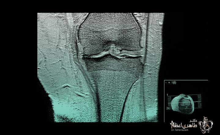MRI برای تشخیص آرتروز زانو