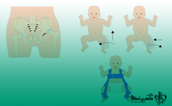 روش های درمان دررفتگی مادرزادی هیپ