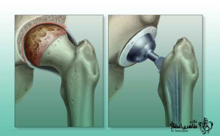 جراحی تعویض مفصل هیپ