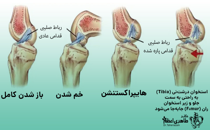 علل هایپراکستنشن