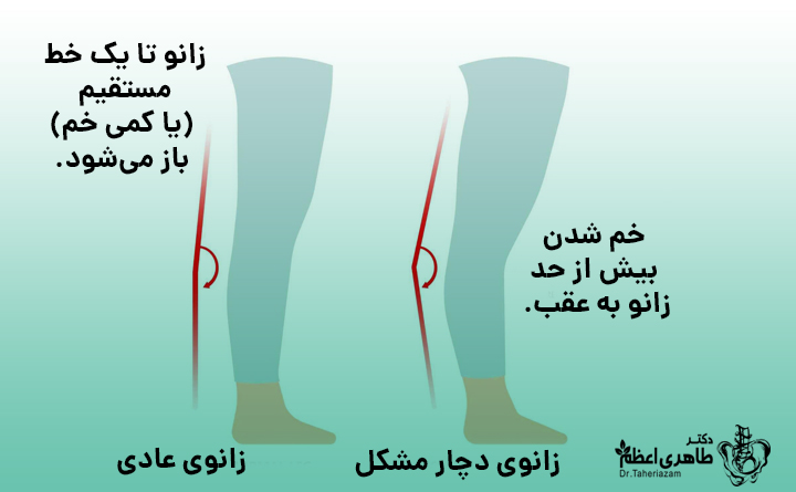 عقب زدگی زانو یا هایپراکستنشن