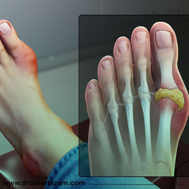 نقرس چیست؟ آیا بیماری نقرس خطرناک است؟