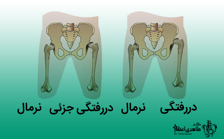 انواع دررفتگی هیپ