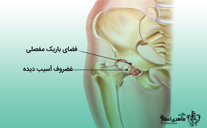 جراحی تعویض مجدد مفصل لگن